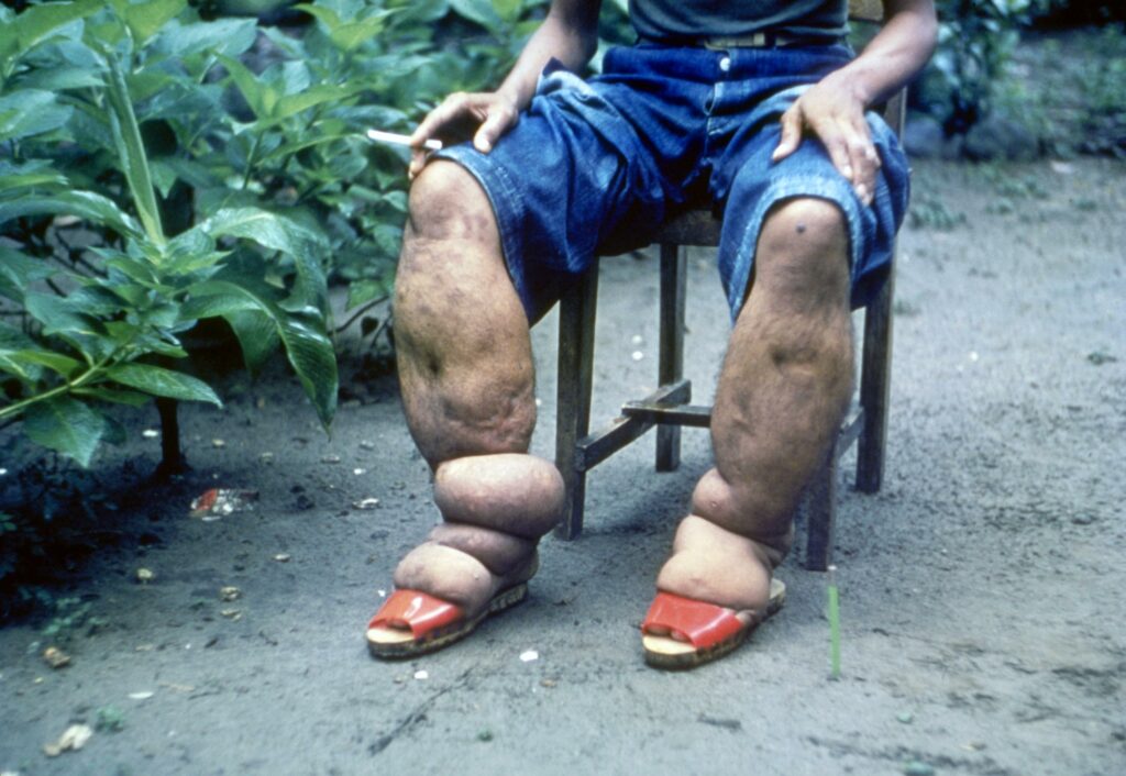 Une « Maladie D’elÉphantiasis » Pour Pays Sous-dÉveloppÉs