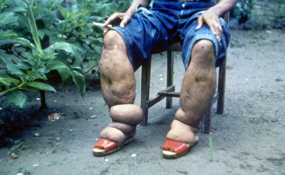 Une « Maladie D’elÉphantiasis » Pour Pays Sous-dÉveloppÉs